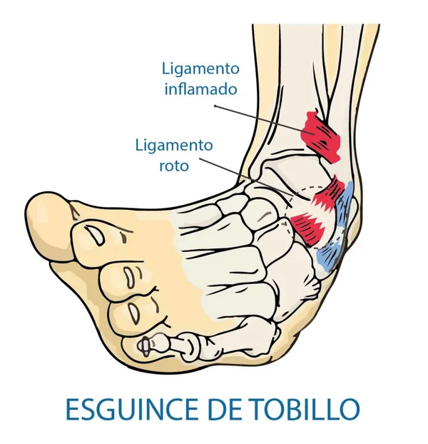 Esguince de tobillo del pie izquierdo